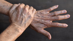 Manchas nas mãos, chamadas melanoses solares: como cuidar