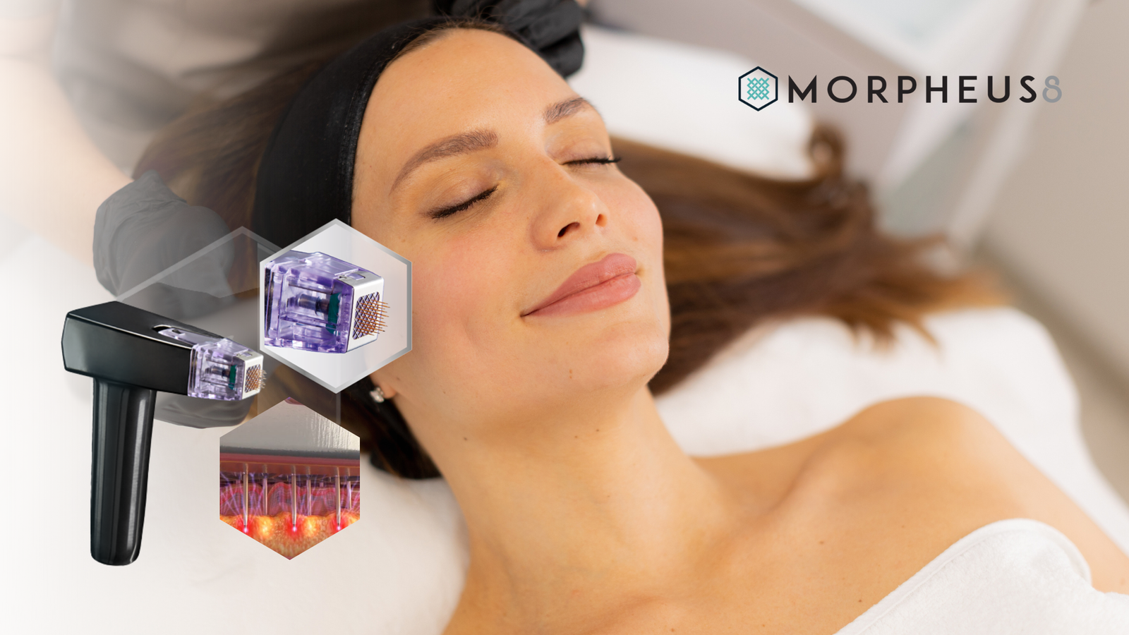 Morpheus 8: Tecnologia Avançada para Rejuvenescimento e Firmeza da Pele – Tudo o que Você Precisa Saber